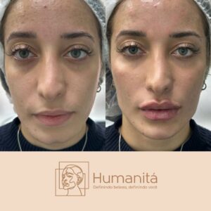 Harmonização Facial antes e depois