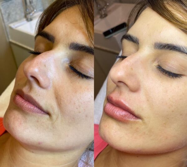 Preenchimento labial antes e depois