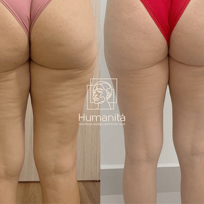 Tratamento celulite antes e depois