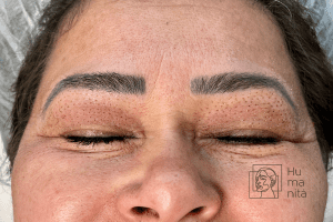 Descubra os benefícios do jato de plasma para tratar rugas, cicatrizes, manchas e muito mais. Conheça os procedimentos não invasivos, resultados e encontre um profissional qualificado para realizar o tratamento de jato de plasma para uma pele rejuvenescida.