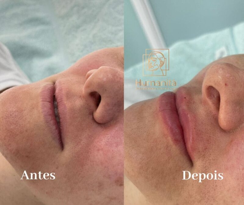 Preenchimento Labial