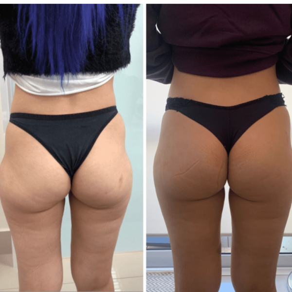 GluteoMax