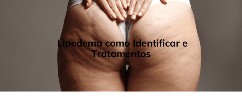  Lipedema como Identificar e Tratamentos