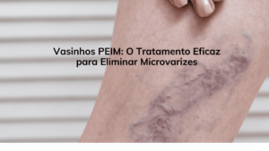 Vasinhos PEIM: O Tratamento Eficaz para Eliminar Microvarizes