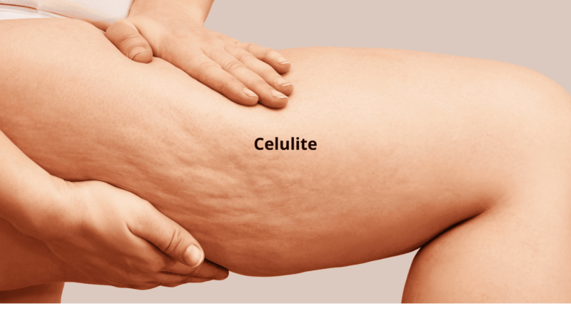 Celulite